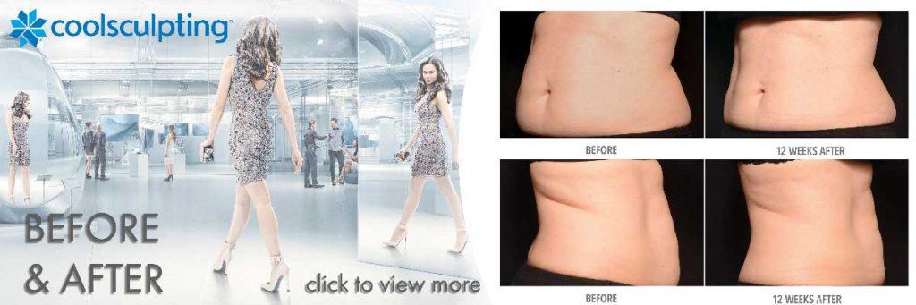 coolsculpting before and after view more