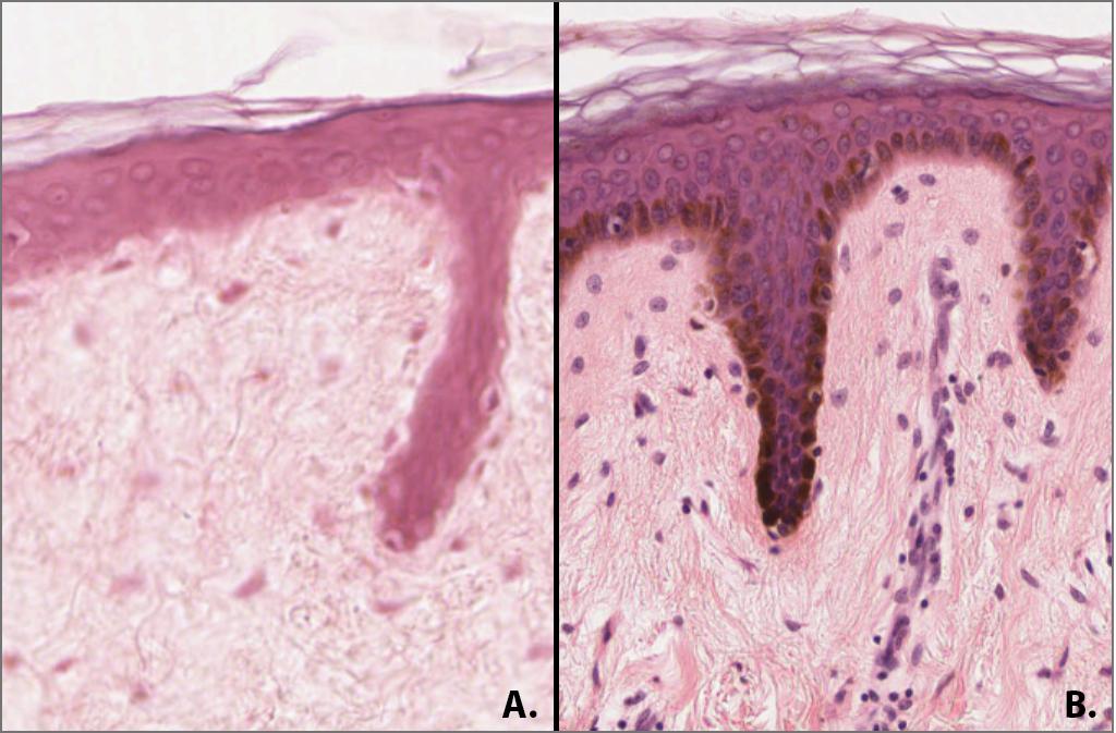 Thin Skin Melanocyte Comparison Histology @400x.png