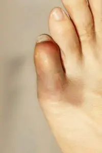 Small Toe / Pinky Toe Pain