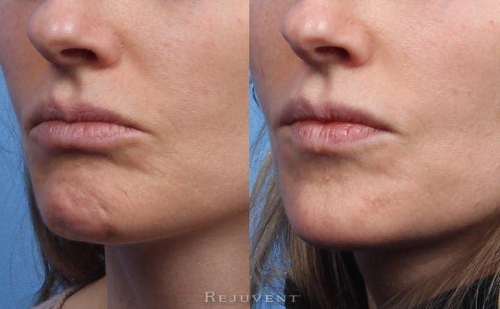 Botox chin crease before and after