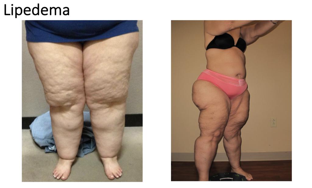 Lipedema vs. Lymphedema