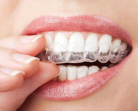 Close-up of a woman putting a clear dental molded tray into her mouth (custom whitening kits)