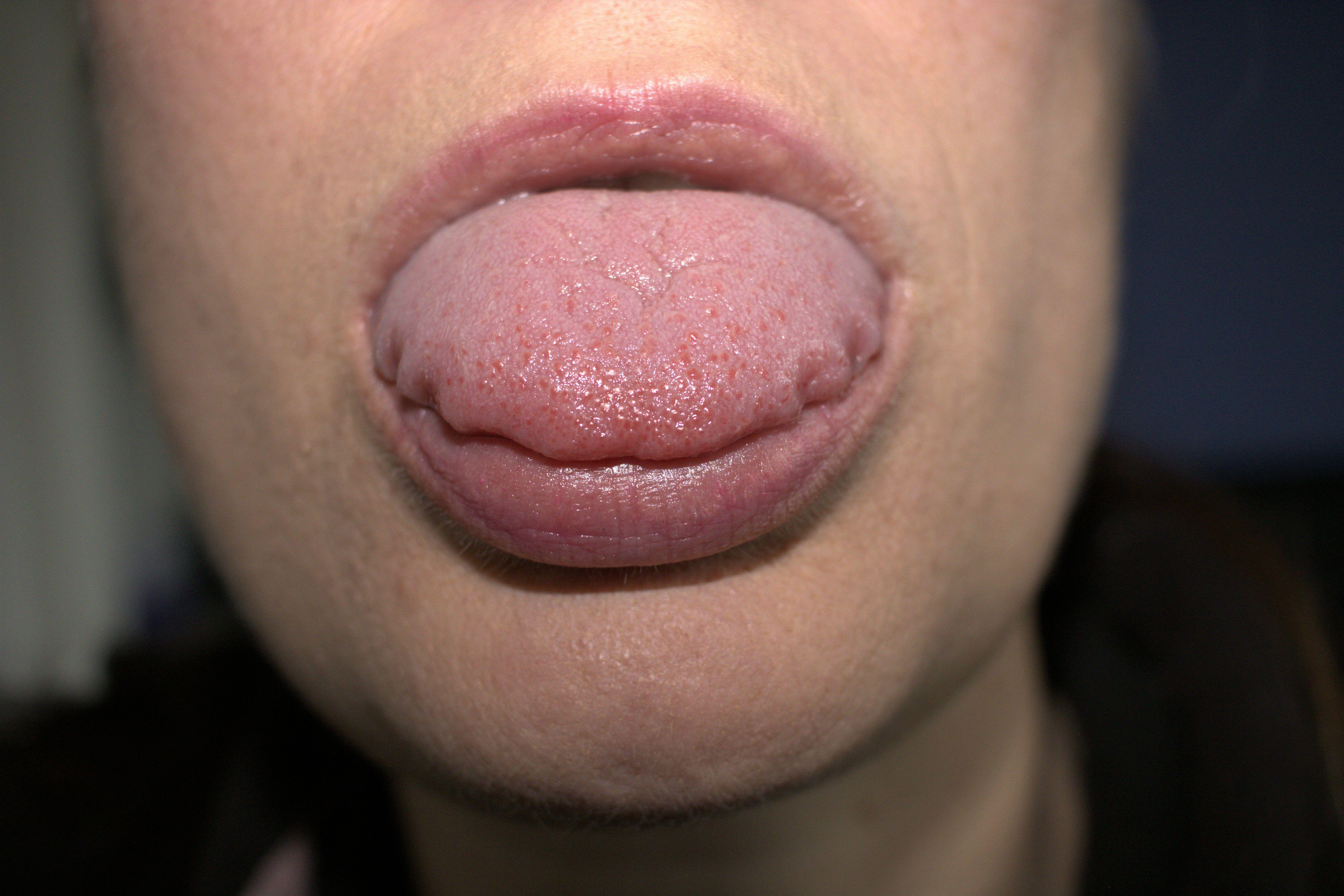 woman with Scalloped Tongue