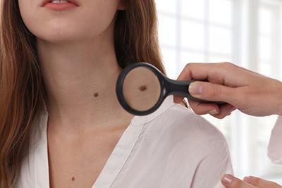 When Should You Get A Mole Checked Out