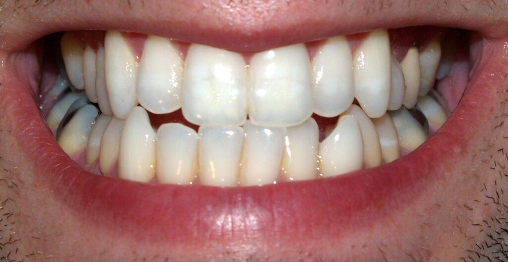 woman drinking water from a glass which helps reduce acids that cause enamel loss and translucent teeth