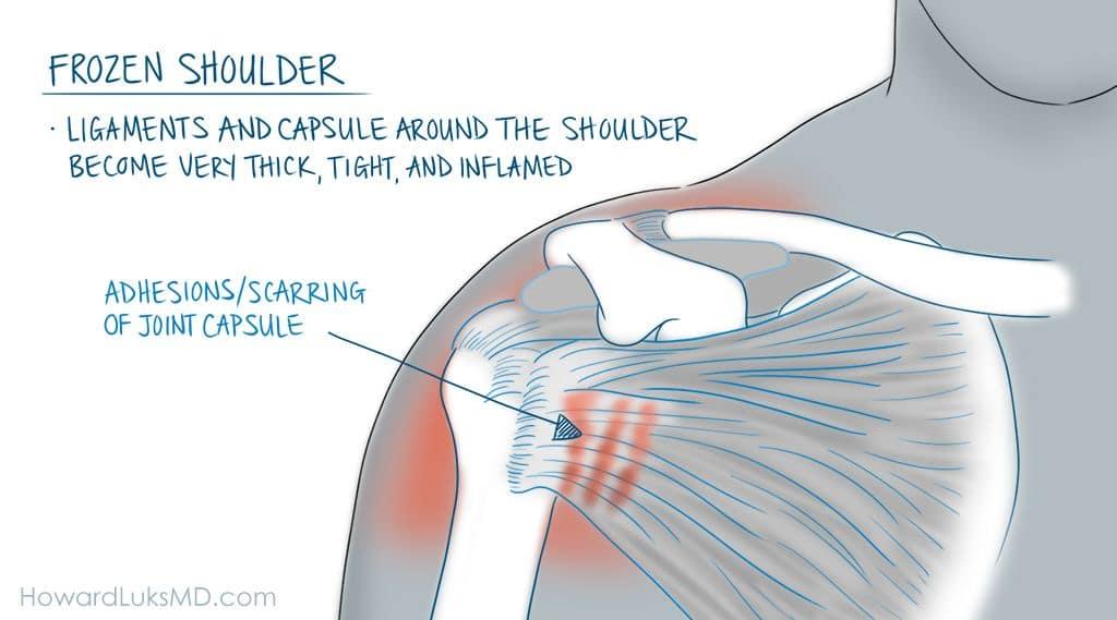 Shoulder Pain When Lifting The Arm : Causes and Cures