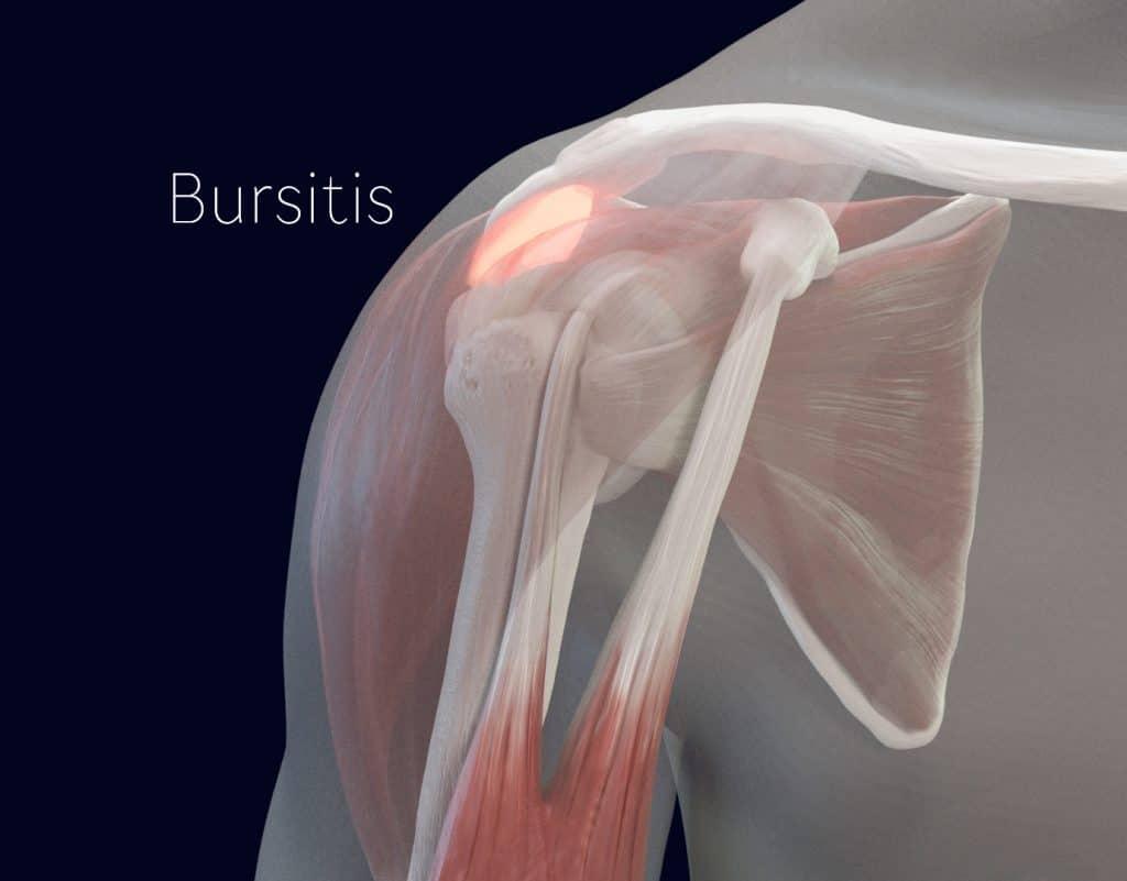 Subacromial bursitis as a cause of night pain