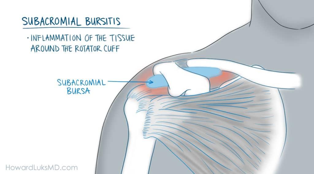 Rotator cuff tears cause pain lifting the arm