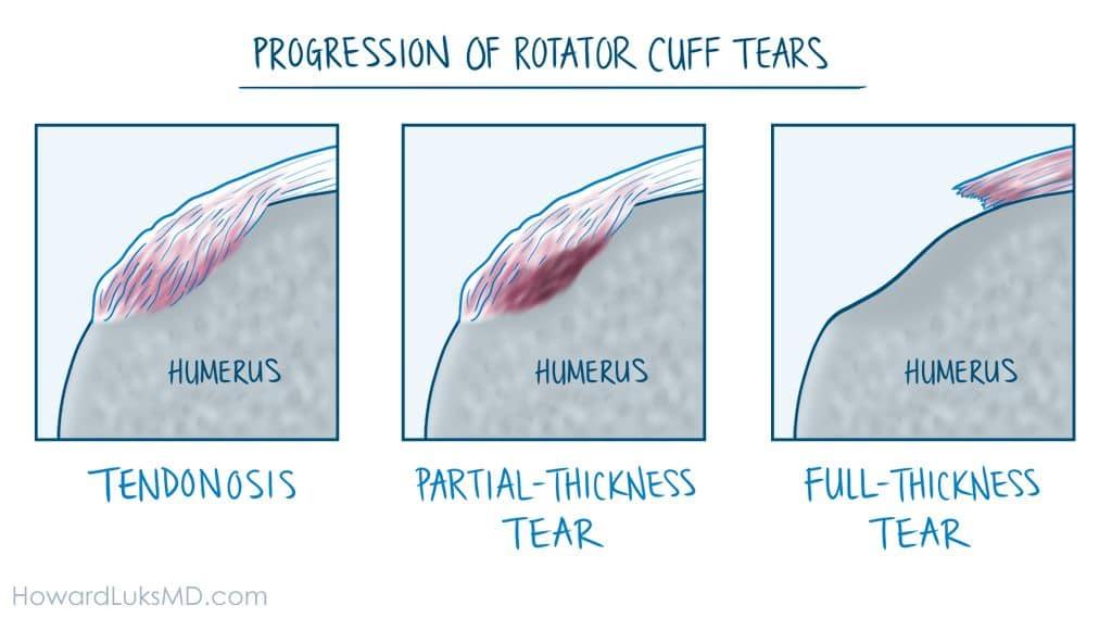 What is calcific tendonitis of the shoulder?