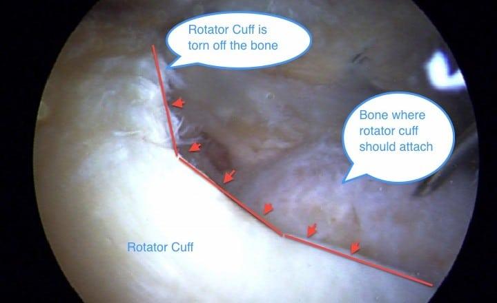 Calcific tendonitis of the rotator cuff causes severe pain when lifting the arm