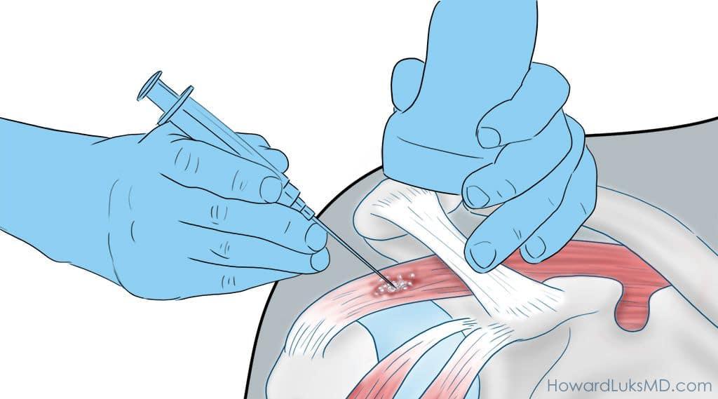 Shoulder Pain When Lifting The Arm : Causes and Cures