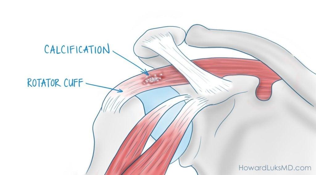 partial rotator cuff tears cause difficulty moving arm