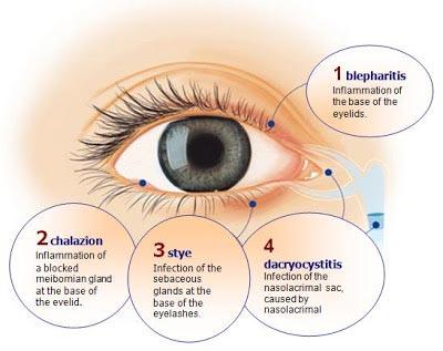 Eyelash Pain, Infected Eyelid Treatment NYC