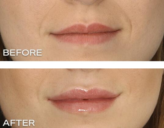filler 2 1 Things to Avoid after Lip Injections - The Dos & Don’ts of Lip Injections - 1