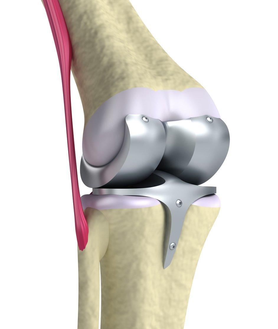 Total knee replacement joint JOI