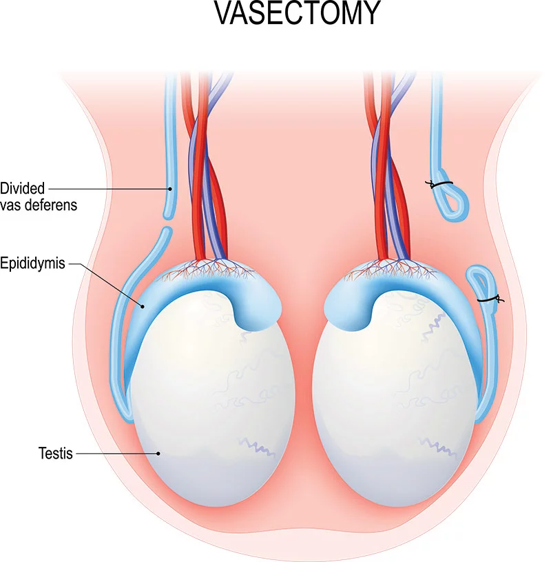 Male reproductive anatomy after a vasectomy. Showing an open-ended method (left) and the ligating/suturing method (right). Photo: Getty Images.