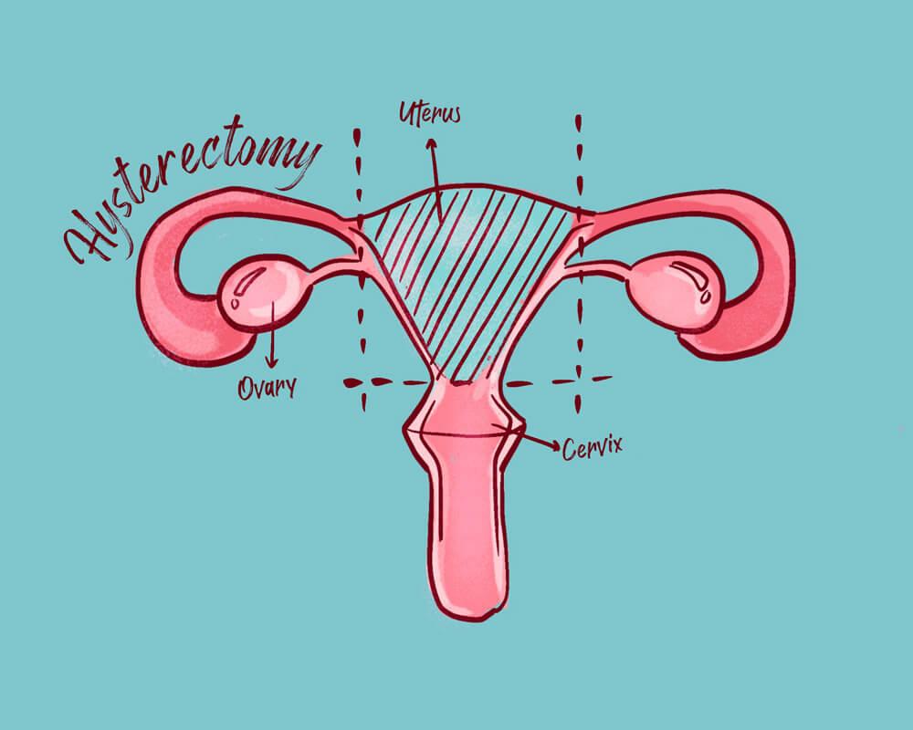 Hysterectomy and Clitoral Atrophy