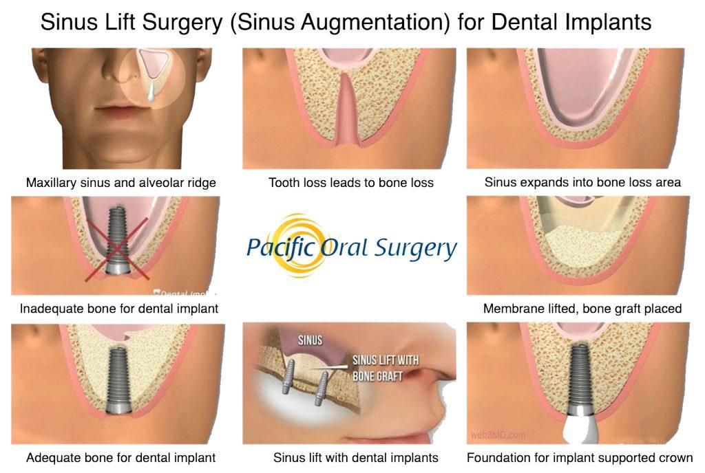 Sinus Lift Surgery for Dental Implants - Pacific Oral Surgery